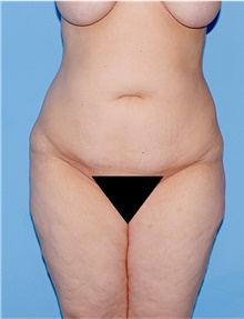 Body Lift Before Photo by Siamak Agha, MD PhD FACS; Newport Beach, CA - Case 43946