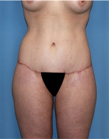 Body Lift After Photo by Siamak Agha, MD PhD FACS; Newport Beach, CA - Case 43951