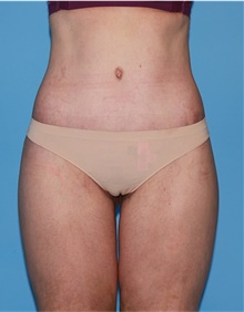 Body Lift After Photo by Siamak Agha, MD PhD FACS; Newport Beach, CA - Case 43953