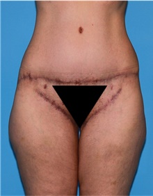 Body Lift Before Photo by Siamak Agha, MD PhD FACS; Newport Beach, CA - Case 43953