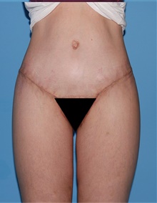 Body Lift After Photo by Siamak Agha, MD PhD FACS; Newport Beach, CA - Case 43953