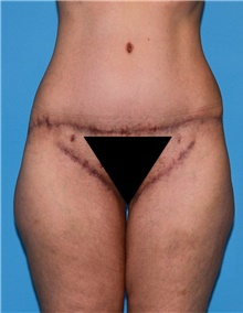 Body Lift Before Photo by Siamak Agha, MD PhD FACS; Newport Beach, CA - Case 43953