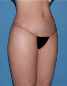 Body Lift After Photo by Siamak Agha, MD PhD FACS; Newport Beach, CA - Case 43953