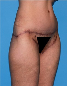 Body Lift Before Photo by Siamak Agha, MD PhD FACS; Newport Beach, CA - Case 43953