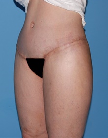 Body Lift After Photo by Siamak Agha, MD PhD FACS; Newport Beach, CA - Case 43953