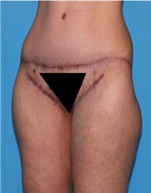 Body Lift Before Photo by Siamak Agha, MD PhD FACS; Newport Beach, CA - Case 43953