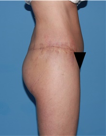 Body Lift After Photo by Siamak Agha, MD PhD FACS; Newport Beach, CA - Case 43953