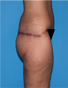 Body Lift Before Photo by Siamak Agha, MD PhD FACS; Newport Beach, CA - Case 43953