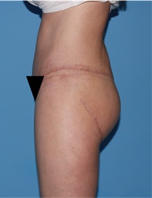 Body Lift After Photo by Siamak Agha, MD PhD FACS; Newport Beach, CA - Case 43953