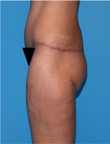 Body Lift Before Photo by Siamak Agha, MD PhD FACS; Newport Beach, CA - Case 43953