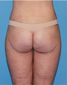 Body Lift After Photo by Siamak Agha, MD PhD FACS; Newport Beach, CA - Case 43953