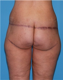 Body Lift Before Photo by Siamak Agha, MD PhD FACS; Newport Beach, CA - Case 43953