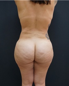 Buttock Lift with Augmentation After Photo by Johnny Franco, MD; Austin, TX - Case 43972