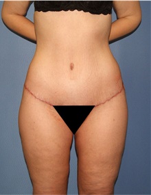 Body Lift After Photo by Siamak Agha, MD PhD FACS; Newport Beach, CA - Case 43977