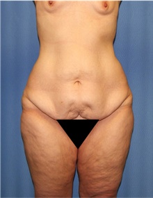 Body Lift Before Photo by Siamak Agha, MD PhD FACS; Newport Beach, CA - Case 43977