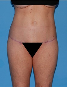 Body Lift After Photo by Siamak Agha, MD PhD FACS; Newport Beach, CA - Case 43978