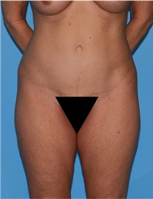 Body Lift Before Photo by Siamak Agha, MD PhD FACS; Newport Beach, CA - Case 43978