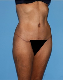 Body Lift After Photo by Siamak Agha, MD PhD FACS; Newport Beach, CA - Case 43978