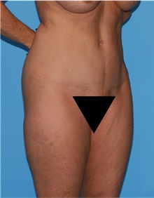 Body Lift Before Photo by Siamak Agha, MD PhD FACS; Newport Beach, CA - Case 43978