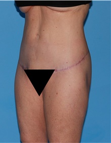 Body Lift After Photo by Siamak Agha, MD PhD FACS; Newport Beach, CA - Case 43978