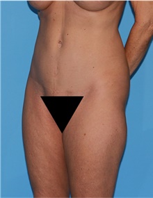 Body Lift Before Photo by Siamak Agha, MD PhD FACS; Newport Beach, CA - Case 43978