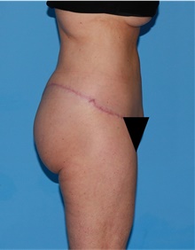 Body Lift After Photo by Siamak Agha, MD PhD FACS; Newport Beach, CA - Case 43978