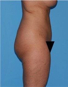 Body Lift Before Photo by Siamak Agha, MD PhD FACS; Newport Beach, CA - Case 43978