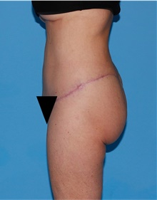 Body Lift After Photo by Siamak Agha, MD PhD FACS; Newport Beach, CA - Case 43978