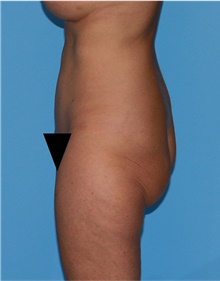 Body Lift Before Photo by Siamak Agha, MD PhD FACS; Newport Beach, CA - Case 43978