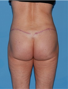 Body Lift After Photo by Siamak Agha, MD PhD FACS; Newport Beach, CA - Case 43978