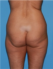 Body Lift Before Photo by Siamak Agha, MD PhD FACS; Newport Beach, CA - Case 43978