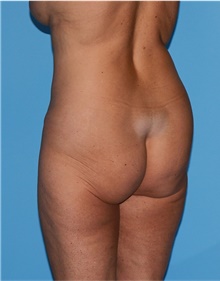 Body Lift Before Photo by Siamak Agha, MD PhD FACS; Newport Beach, CA - Case 43978