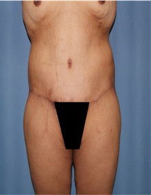 Body Lift After Photo by Siamak Agha, MD PhD FACS; Newport Beach, CA - Case 43981