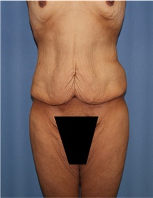 Body Lift Before Photo by Siamak Agha, MD PhD FACS; Newport Beach, CA - Case 43981