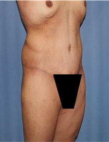 Body Lift After Photo by Siamak Agha, MD PhD FACS; Newport Beach, CA - Case 43981