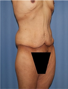 Body Lift Before Photo by Siamak Agha, MD PhD FACS; Newport Beach, CA - Case 43981