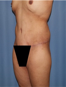 Body Lift After Photo by Siamak Agha, MD PhD FACS; Newport Beach, CA - Case 43981