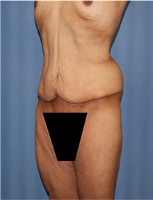 Body Lift Before Photo by Siamak Agha, MD PhD FACS; Newport Beach, CA - Case 43981