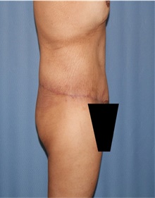 Body Lift After Photo by Siamak Agha, MD PhD FACS; Newport Beach, CA - Case 43981