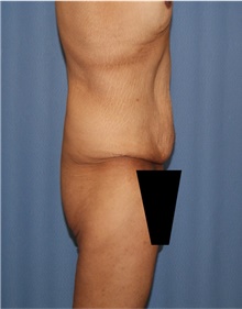 Body Lift Before Photo by Siamak Agha, MD PhD FACS; Newport Beach, CA - Case 43981