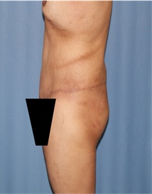 Body Lift After Photo by Siamak Agha, MD PhD FACS; Newport Beach, CA - Case 43981