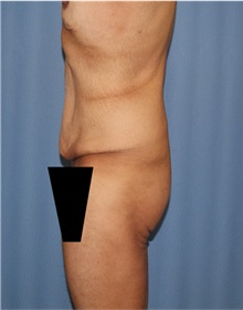 Body Lift Before Photo by Siamak Agha, MD PhD FACS; Newport Beach, CA - Case 43981