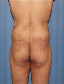 Body Lift After Photo by Siamak Agha, MD PhD FACS; Newport Beach, CA - Case 43981