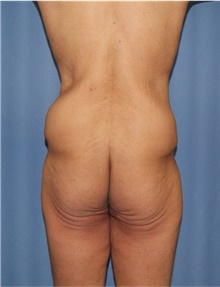 Body Lift Before Photo by Siamak Agha, MD PhD FACS; Newport Beach, CA - Case 43981