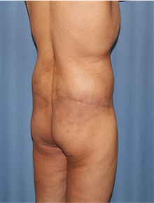 Body Lift After Photo by Siamak Agha, MD PhD FACS; Newport Beach, CA - Case 43981