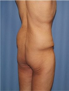 Body Lift Before Photo by Siamak Agha, MD PhD FACS; Newport Beach, CA - Case 43981