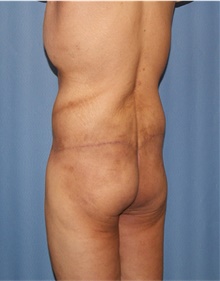 Body Lift After Photo by Siamak Agha, MD PhD FACS; Newport Beach, CA - Case 43981