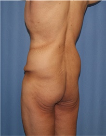 Body Lift Before Photo by Siamak Agha, MD PhD FACS; Newport Beach, CA - Case 43981