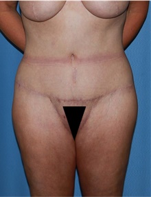 Body Lift After Photo by Siamak Agha, MD PhD FACS; Newport Beach, CA - Case 43984