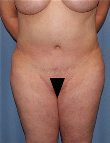 Body Lift Before Photo by Siamak Agha, MD PhD FACS; Newport Beach, CA - Case 43984